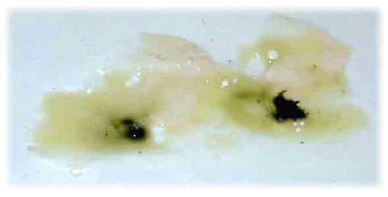 Coughing up thick and dark green mucus?.